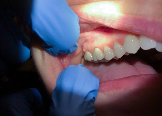 Best Emergency Tooth Extraction in Country Squire Lakes, IN